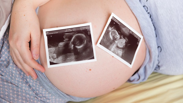 cara hamil bayi kembar