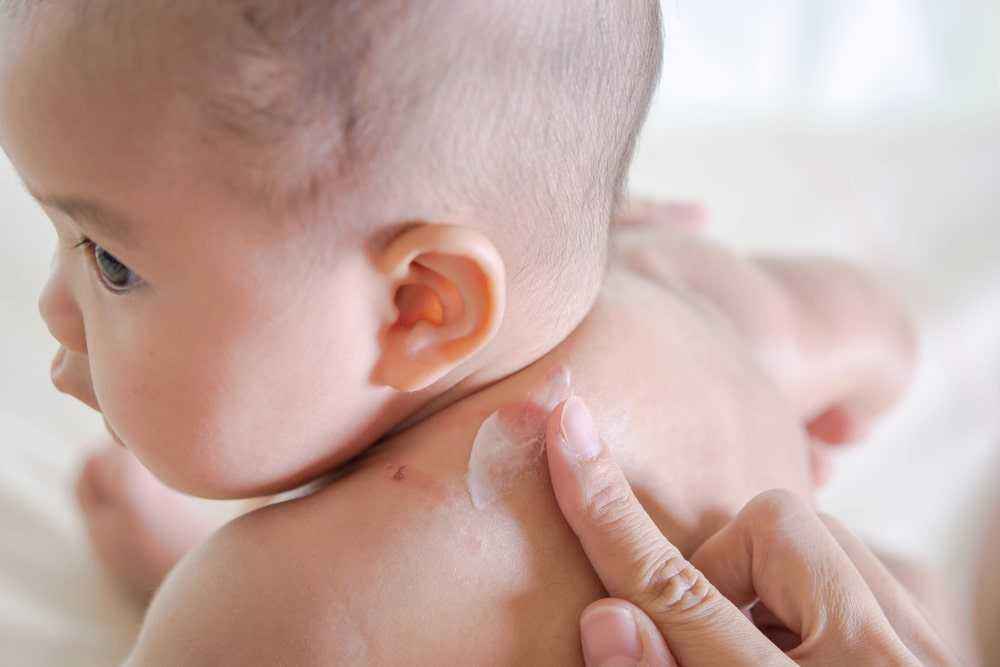 Cara Mengatasi Alergi Makanan pada Bayi