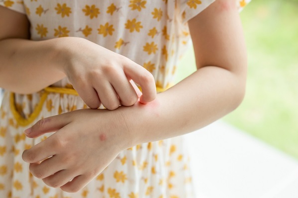 Perbedaan gejala campak dan alergi - ibudanbalita