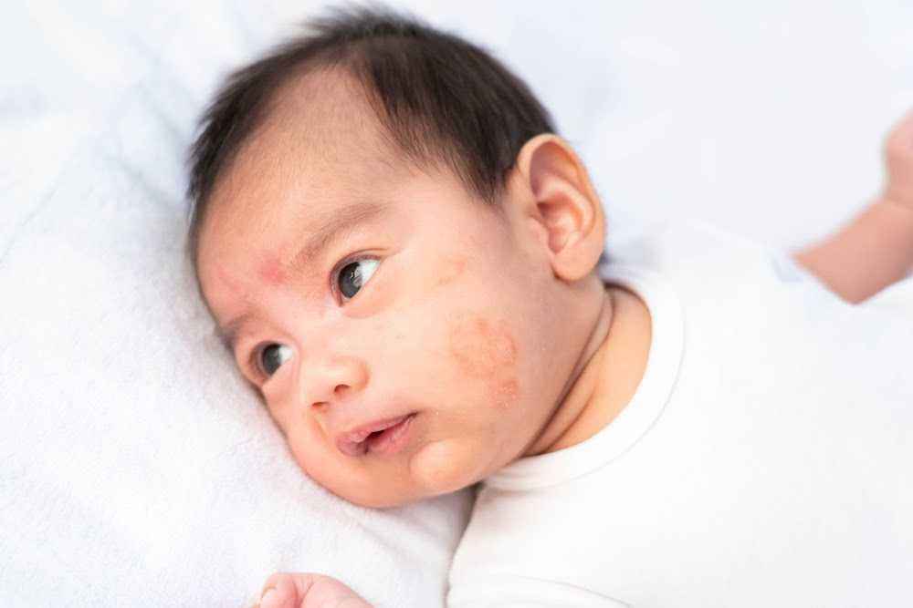 Cara mengatasi bintik merah pada wajah bayi