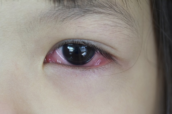 faktor penyebab mata merah pada anak - ibudanbalita