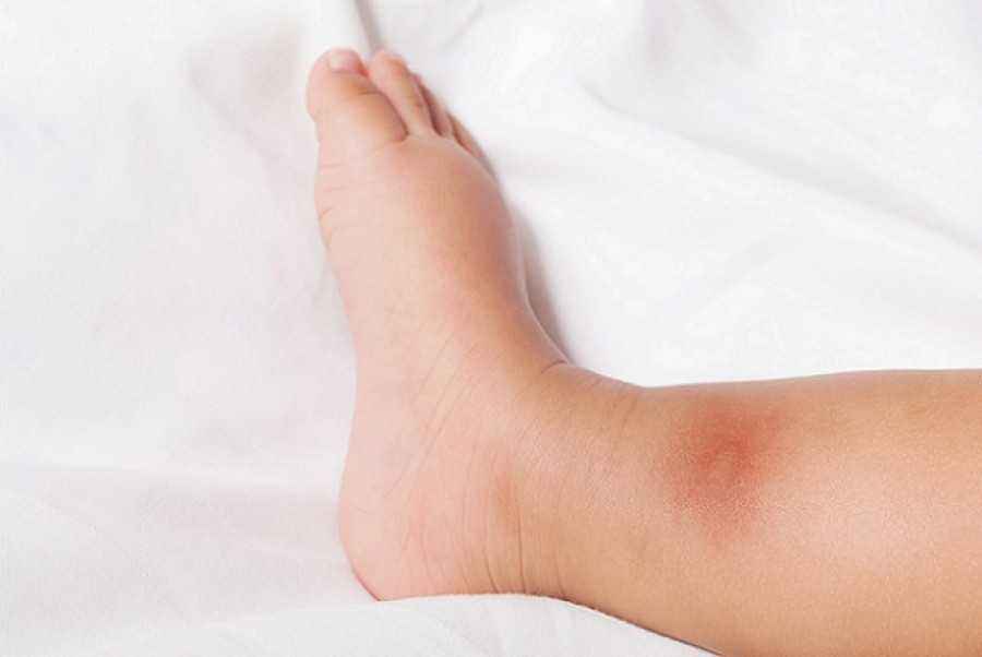 6 Pertolongan Pertama untuk Luka Bakar Anak. Ibu Wajib Tahu!