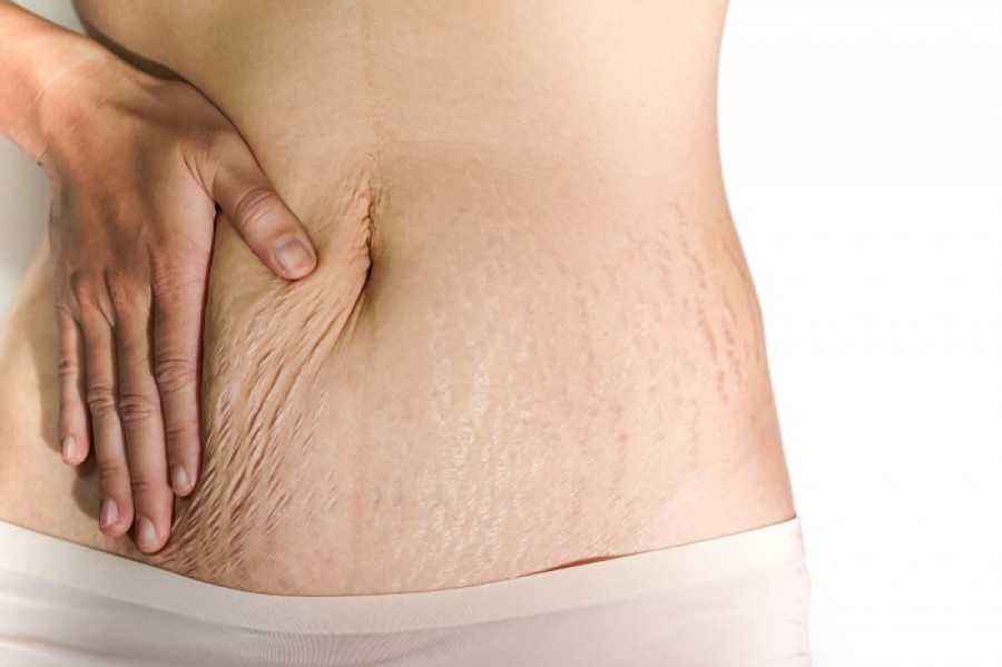 Ini Penyebab Stretch Mark dan Tips Menghilangkannya