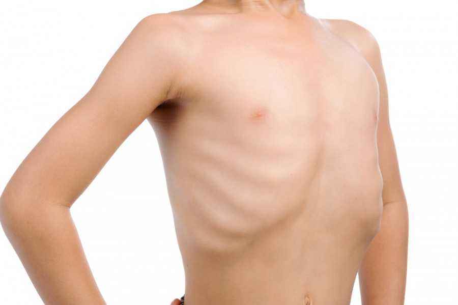 5 Faktor Risiko Malnutrisi pada Anak dan Pencegahannya