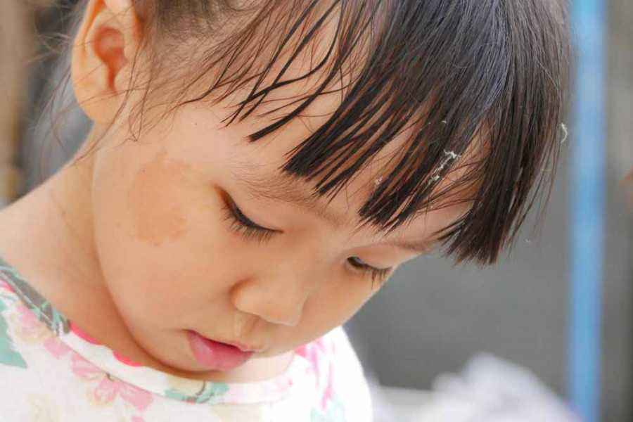 Atasi Tanda Lahir yang Nampak Mengganggu pada si Kecil