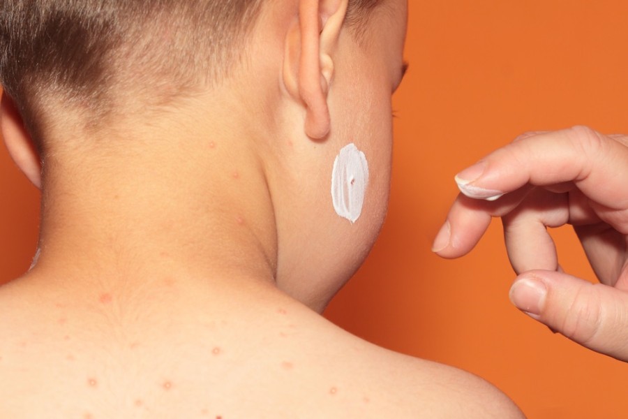 Atasi Cacar Air pada Anak dengan 5 Cara Alami Ini, Bu