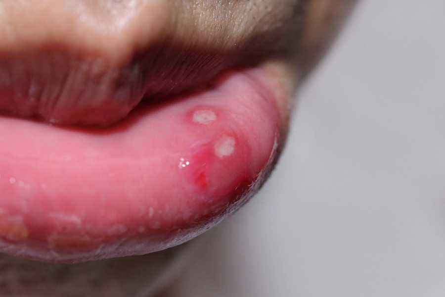 Cold Sores: Kenali Gejala, Penyebab, dan Cara Mengobati