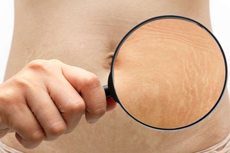 5 Cara Menghilangkan Stretch Marks Setelah Melahirkan