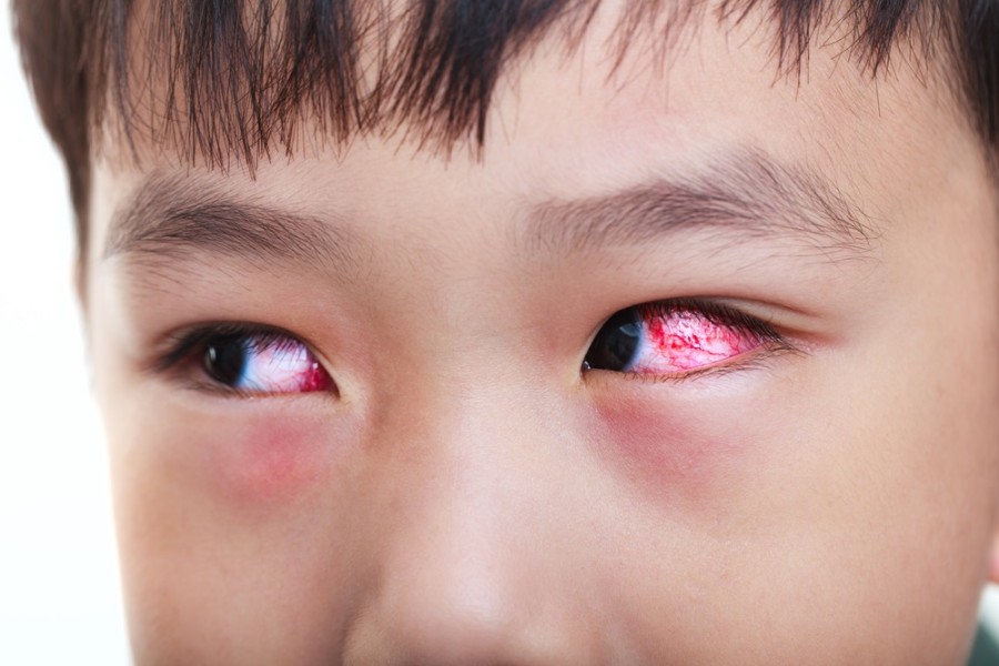 Waspadai 3 Faktor Penyebab Mata Merah pada Anak