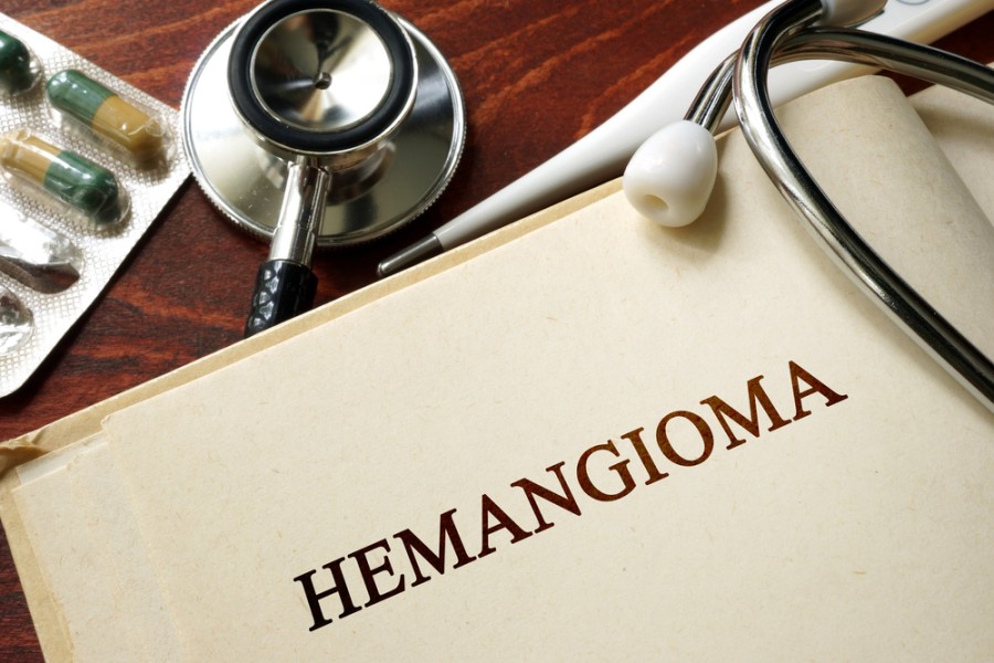 Hemangioma, Kenali Gejala, Penyebab, & Pengobatannya