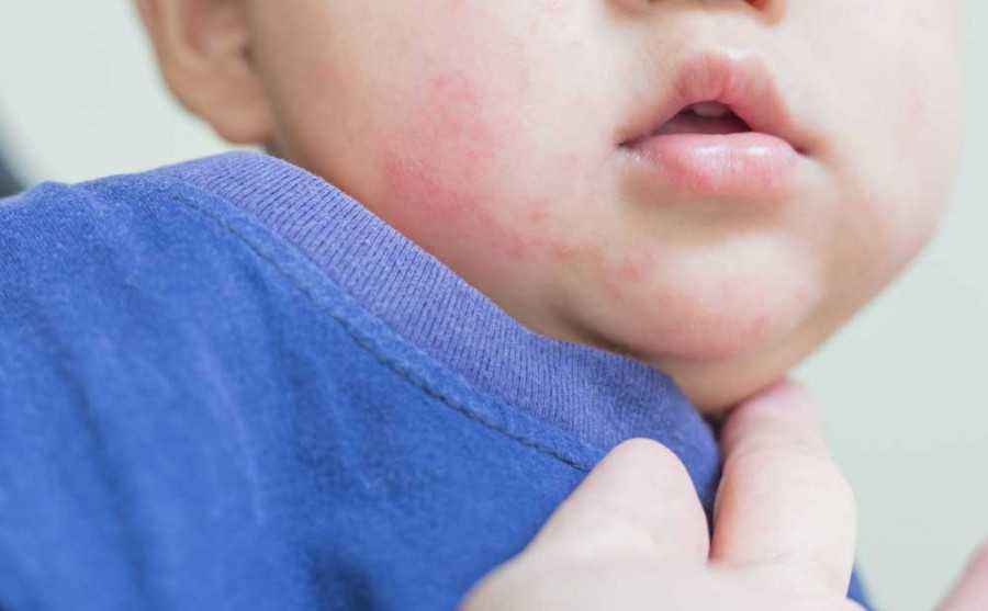 Herpes kulit disebabkan oleh