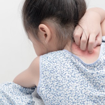 7 Cara Efektif Mengatasi Biang Keringat pada Anak