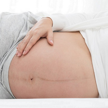 Linea Nigra Adalah Garis Hitam di Perut Bumil, Normalkah?