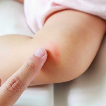 Mengenal Tanda Hingga Penanganan Vitiligo pada Bayi