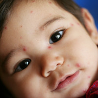 Kenali Gangguan Kulit Wajah Bayi 0-6 Bulan 
