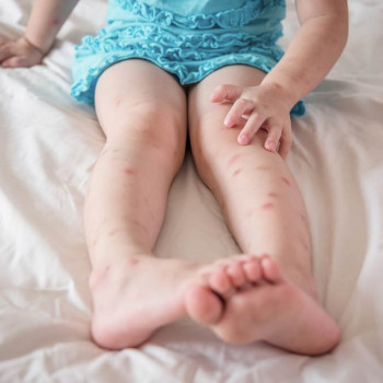 6 Cara Alami Redakan Gatal pada Kulit Bayi dan Anak