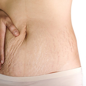 Ini Penyebab Stretch Mark dan Tips Menghilangkannya