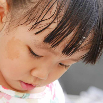 Atasi Tanda Lahir yang Nampak Mengganggu pada si Kecil