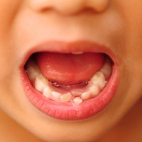 Perawatan Anak Saat Gigi Tanggal