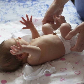 Hernia Pada Bayi: Waspadai dan Kenali 3 Penyebabnya