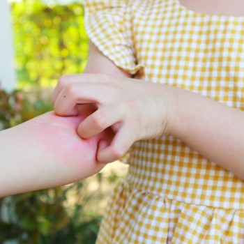 Jangan Salah, Ini Perbedaan Campak dan Alergi pada Anak