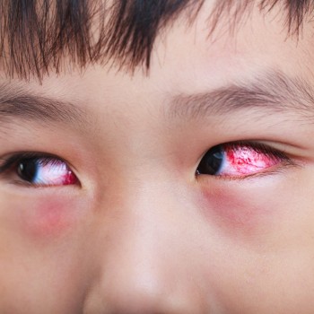 Bu, Ini 3 Faktor Penyebab Mata Merah pada Anak