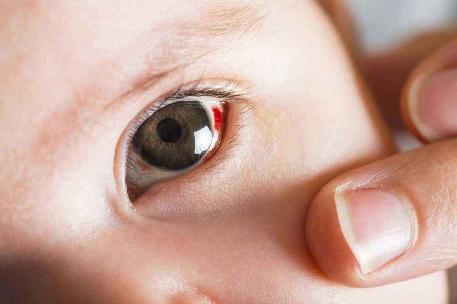 Yuk Simak Kondisi Mata Merah pada Si Kecil dan Cara Menanganinya